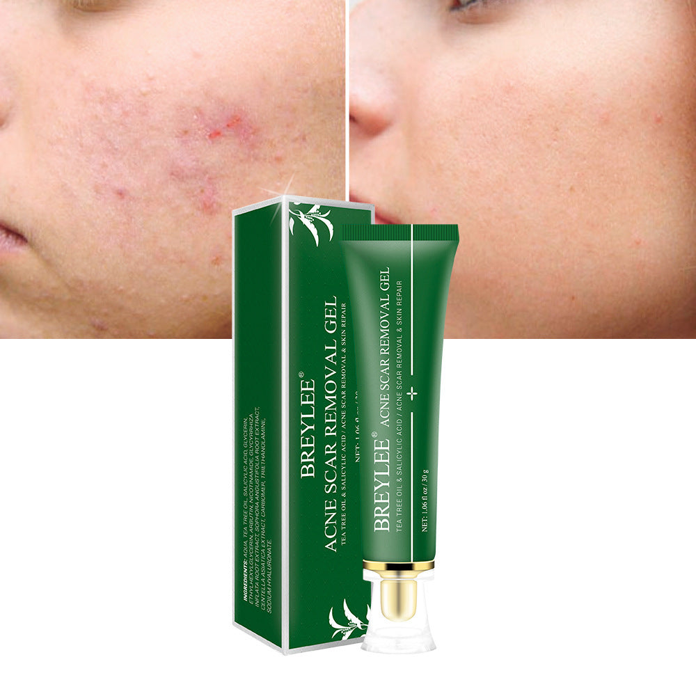 Acne Scar Removal Gel Tea Tree Qu Dou utskrift