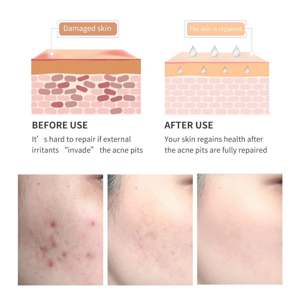 Acne Scar Removal Gel Tea Tree Qu Dou utskrift